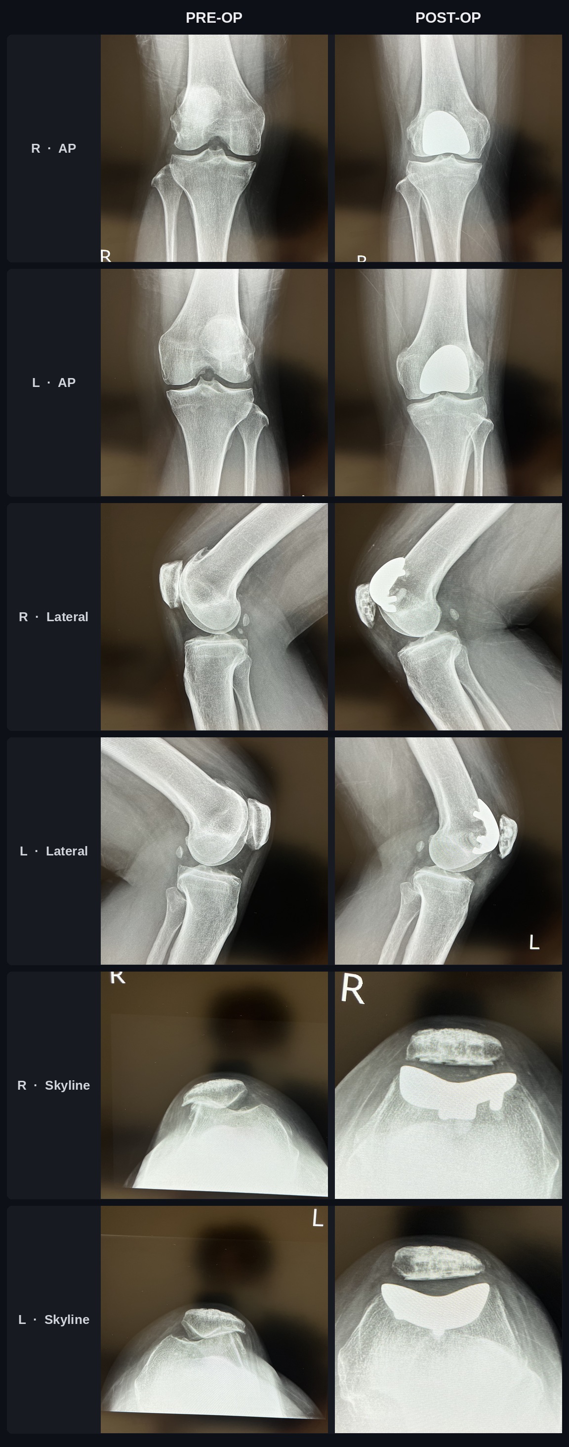 X-ray comparison before and after patellofemoral arthroplasty (PFA), AP, lateral, and skyline views