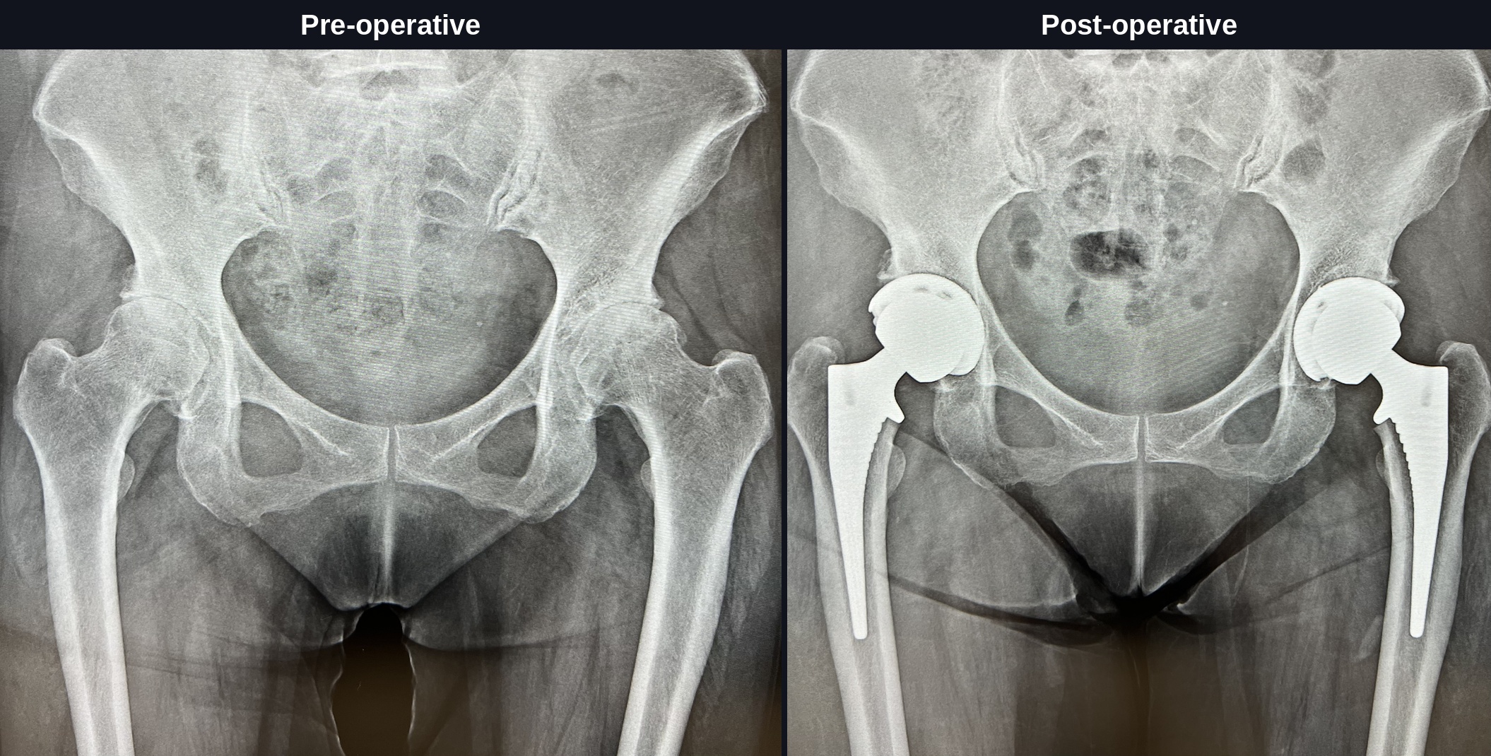 X-ray comparison of hip joint before and after total hip arthroplasty (THA)