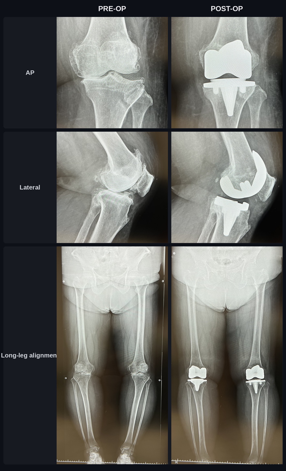 X-ray comparison before and after total knee arthroplasty (TKA), AP, lateral, and long-leg alignment views