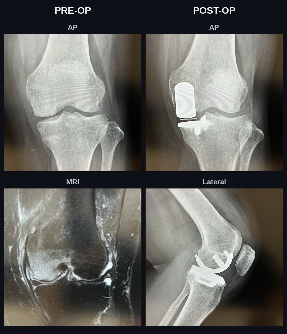 Pre-operative and post-operative imaging for unicompartmental knee arthroplasty (UKA)